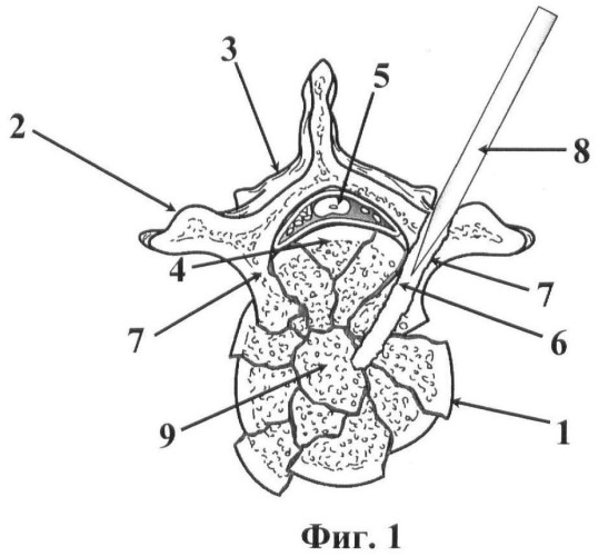 Способ декомпрессии спинного мозга при переломах грудных и поясничных позвонков (патент 2467716)