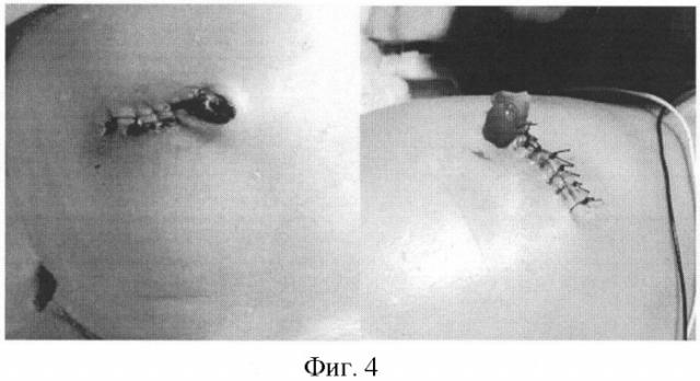 Способ пластики при врожденных пороках передней брюшной стенки у новорожденных детей (патент 2390309)